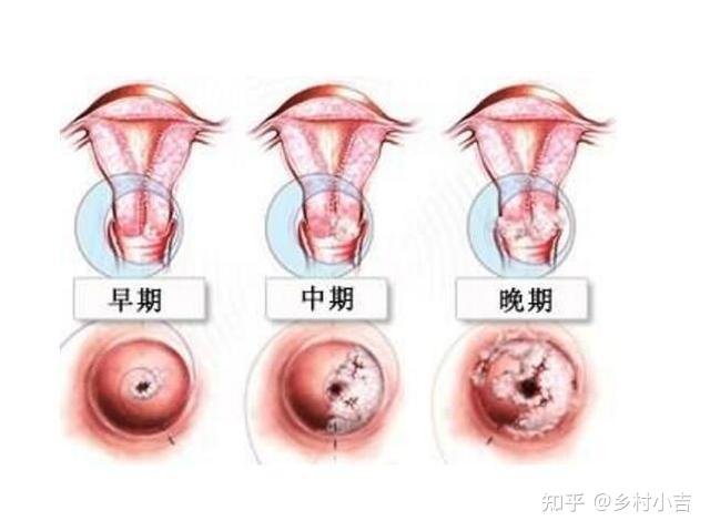 12岁女孩感染hpv怎么办