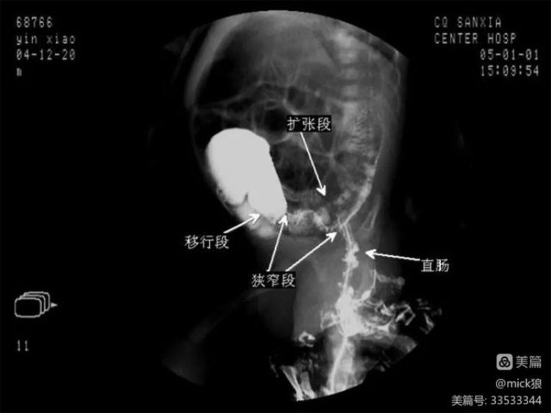 女子在家自行灌肠引发水中毒事件，深度解析与警示